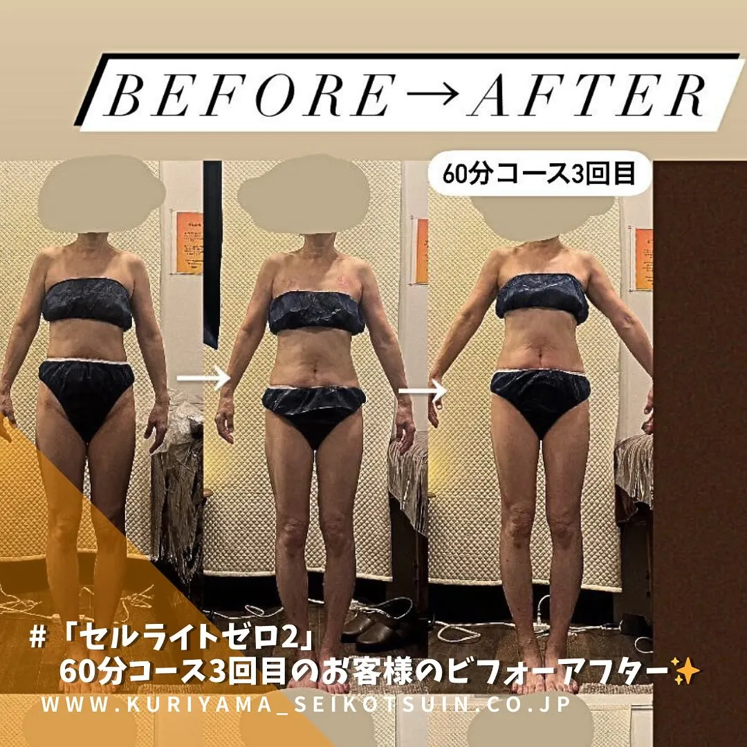 西宮のエステと整骨院なら栗山整骨院 Bodyリカバリー💪「セルライトゼロ2」で痩身ダイエット60分コースを3回受けたお客様のビフォーアフターの写真✨