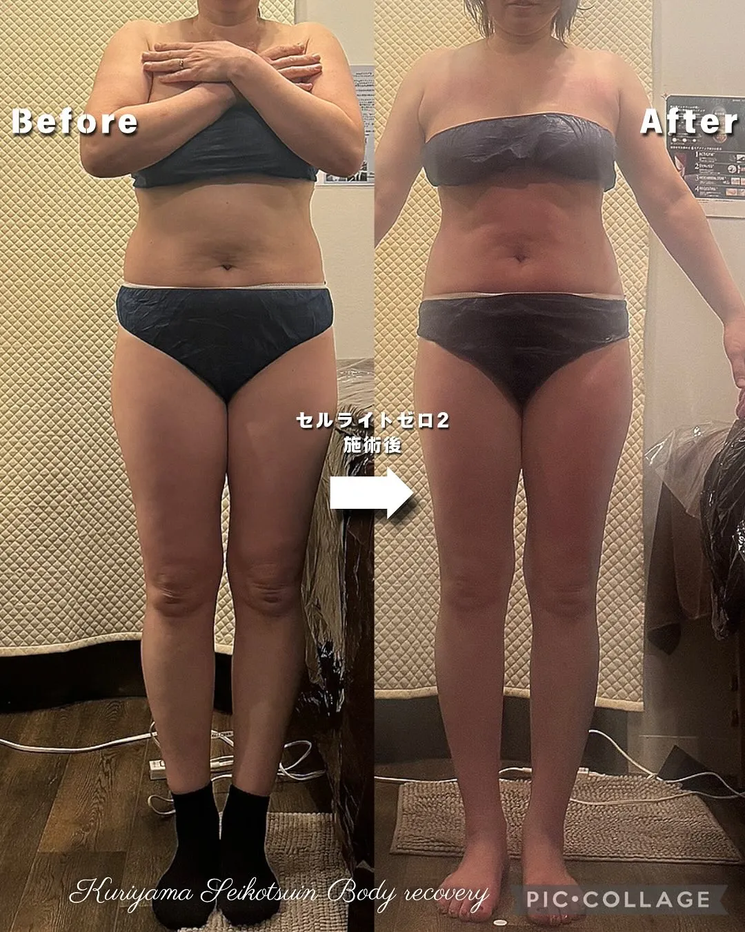 食べたものを脂肪やセルライトにしない為には何日以内に消化すれ...