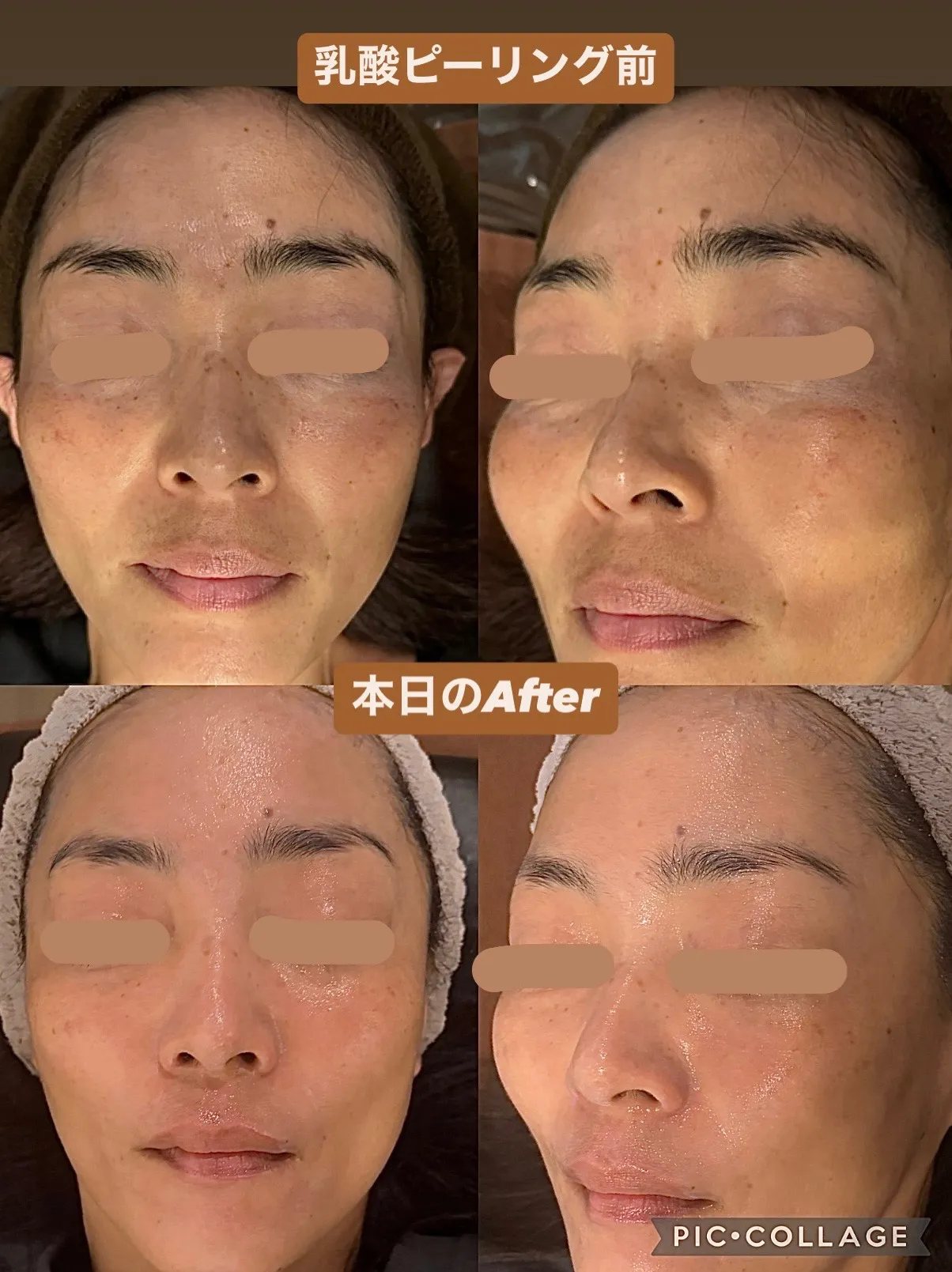乳酸ピーリングのビフォーアフター