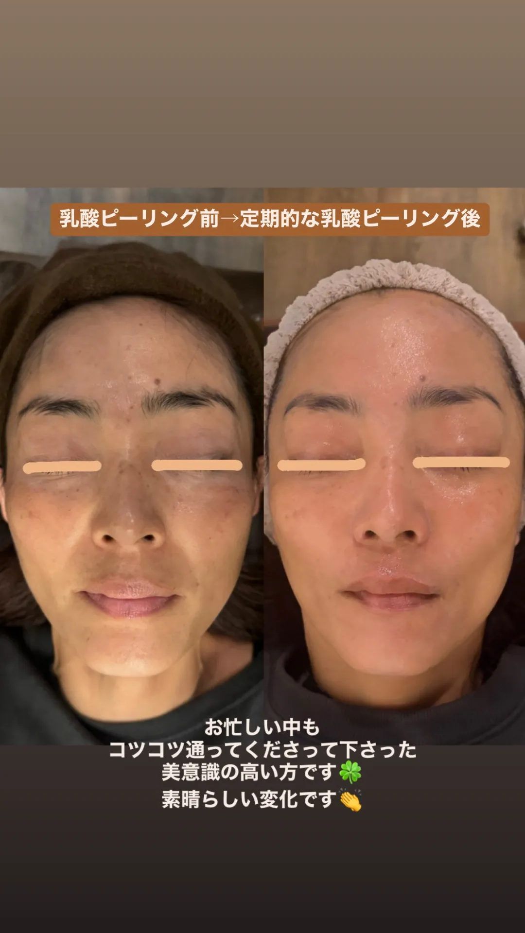 乳酸ピーリングのビフォーアフター